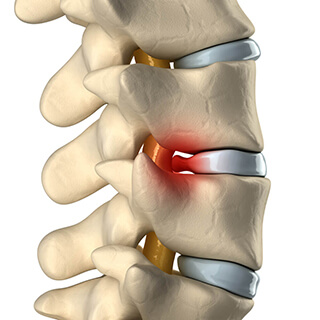 Microendoscopic Discectomy Baton Rouge | Spinal Stenosis LA